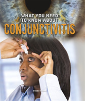 What You Need to Know about Conjunctivitis