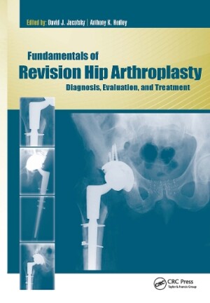Fundamentals of Revision Hip Arthroplasty