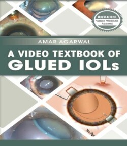 Video Textbook of Glued IOLs