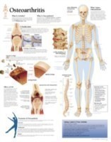 Osteoarthritis Paper Poster