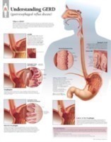 Understanding GERD (Gastroesophageal Reflux Disease) Laminated Poster