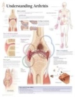 Understanding Arthritis Laminated Poster