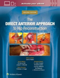 Direct Anterior Approach to Hip Reconstruction