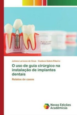 O uso de guia cirúrgico na instalação de implantes dentais