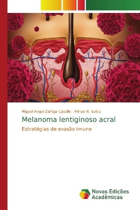 Melanoma lentiginoso acral