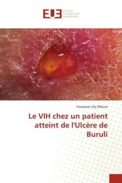 VIH chez un patient atteint de l'Ulcère de Buruli