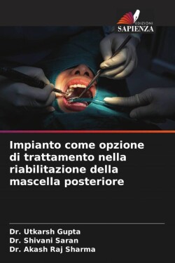 Impianto come opzione di trattamento nella riabilitazione della mascella posteriore