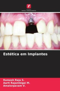 Estética em Implantes