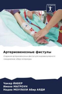 Артериовенозные фистулы