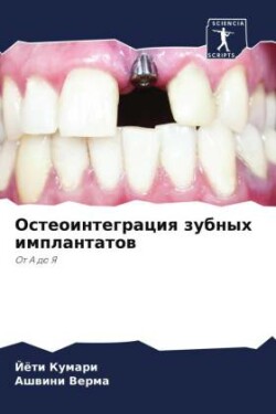 Остеоинтеграция зубных имплантатов