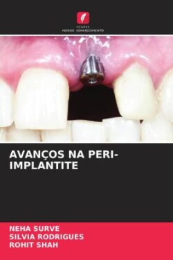 AVANÇOS NA PERI-IMPLANTITE