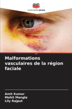 Malformations vasculaires de la région faciale