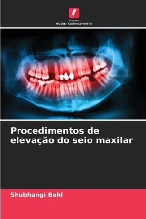 Procedimentos de elevação do seio maxilar