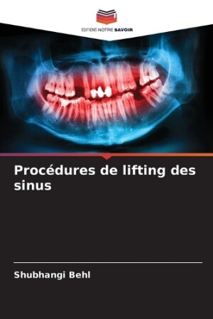 Procédures de lifting des sinus