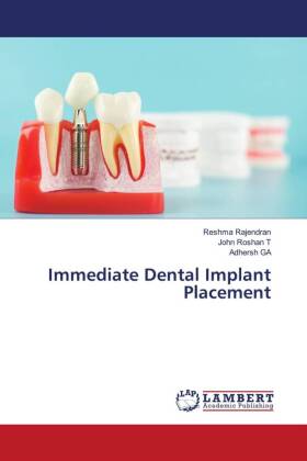 Immediate Dental Implant Placement