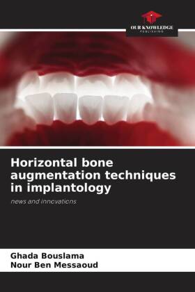 Horizontal bone augmentation techniques in implantology