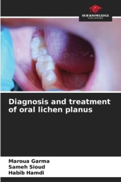 Diagnosis and treatment of oral lichen planus