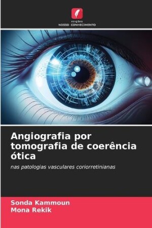 Angiografia por tomografia de coerência ótica