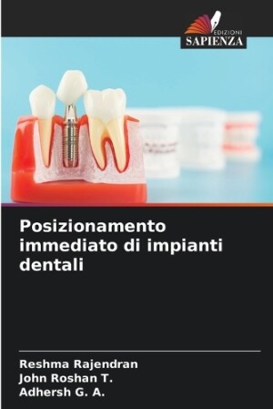 Posizionamento immediato di impianti dentali